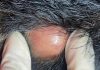 Big Cystic Blackheads Extraction