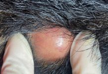 Big Cystic Blackheads Extraction