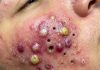 Big Cystic Blackheads Extraction Whiteheads