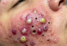 Big Cystic Blackheads Extraction Whiteheads