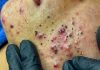 Blackheads Extraction Blackheads
