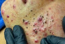 Blackheads Extraction Blackheads