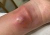 Blackheads Extraction