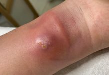 Blackheads Extraction