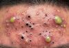 Blackheads Extraction Whiteheads