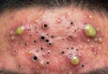 Blackheads Extraction Whiteheads