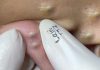 Cystic Extraction Whiteheads