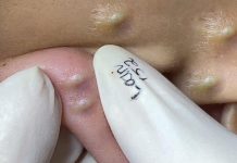 Cystic Extraction Whiteheads