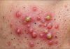 Cystic Blackheads Extraction Whiteheads