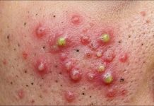 Cystic Blackheads Extraction Whiteheads