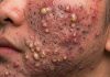 Cystic Acne Blackheads Extraction