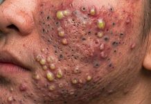 Cystic Acne Blackheads Extraction