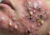 Cystic Acne Blackheads Extraction Whiteheads