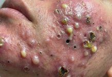 Cystic Acne Blackheads Extraction Whiteheads