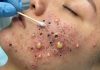 Acne Blackheads Extraction Whiteheads