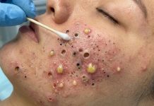 Acne Blackheads Extraction Whiteheads