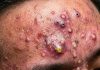 Blackheads Extraction