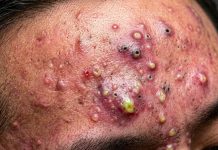 Blackheads Extraction