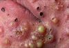 Big Cystic Blackheads Extraction
