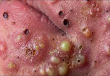 Big Cystic Blackheads Extraction