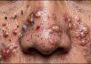 Acne Blackheads Extraction