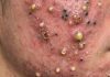 Blackheads Extraction Whiteheads