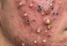 Blackheads Extraction Whiteheads