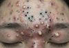 Blackheads Extraction Whiteheads