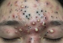Blackheads Extraction Whiteheads