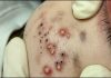 Cystic Extraction Whiteheads
