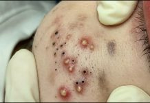 Cystic Extraction Whiteheads