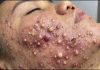 Cystic Acne Blackheads Extraction Whiteheads