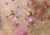 Cystic Acne Blackheads Extraction