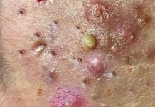 Cystic Acne Blackheads Extraction