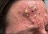 Blackheads Extraction Whiteheads