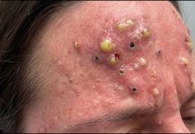 Blackheads Extraction Whiteheads