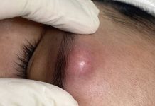 Big Blackheads Extraction