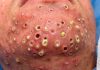 Blackheads Extraction Whiteheads