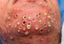 Blackheads Extraction Whiteheads