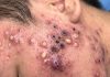 Cystic Acne Blackheads Extraction