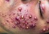Cystic Acne Blackheads Extraction