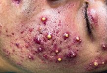 Cystic Acne Blackheads Extraction
