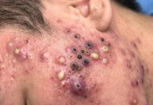 Cystic Acne Blackheads Extraction