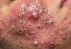 Acne Blackheads Extraction