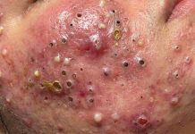 Acne Blackheads Extraction
