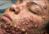 Big Cystic Acne Blackheads Extraction