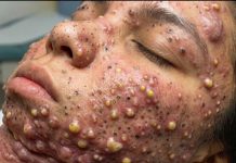 Big Cystic Acne Blackheads Extraction