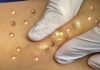 Blackheads Extraction and Whiteheads