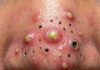Cystic Blackheads Extraction