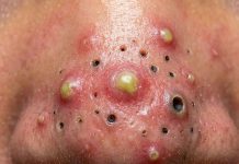 Cystic Blackheads Extraction